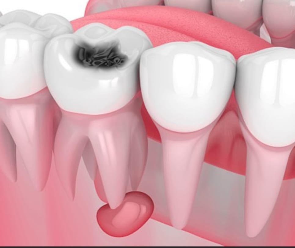 Oral Cyst Tumor Surgery