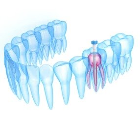 Post And Core Therapy