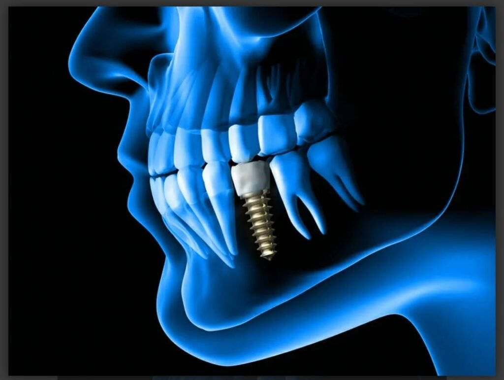 dental implant 1024x771